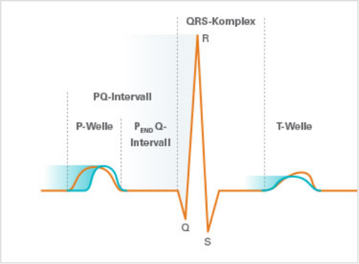Abbildung einer EKG-Kurve bei Morbus Fabry