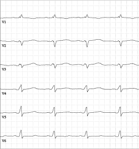 Abbildung typische EKG-Kurve bei kardialer Amyloidose