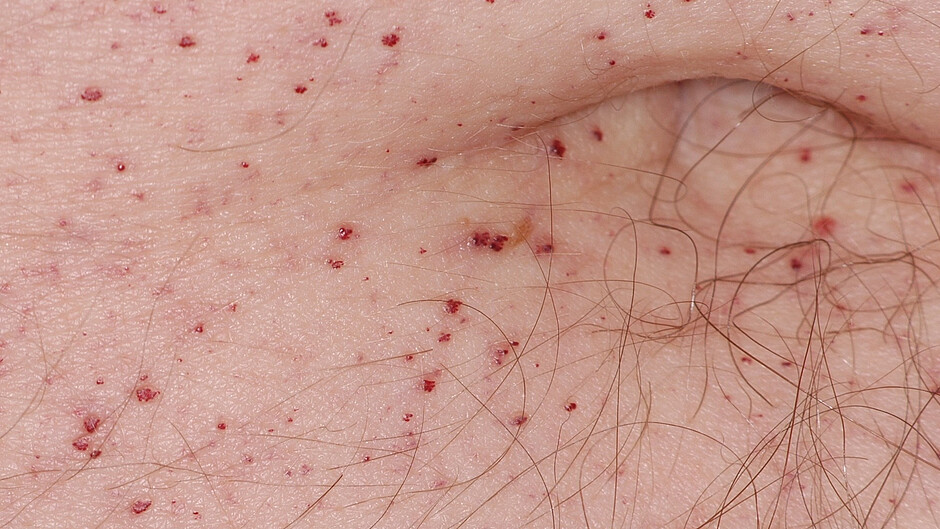 Typische Angiokeratome im Bereich des Bauchnabels bei Morbus Fabry