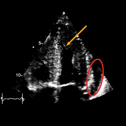 GIF Echokardiographie Vierkammerblick bei kardialer Amyloidose