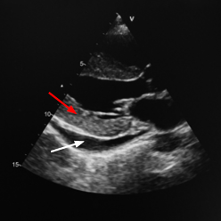 Abbildung Echokardiographie Sparkling Myokardium und Perikarderguss bei kardialer Amyloidose