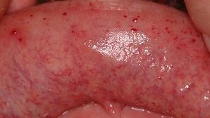 Angiome im Mundbereich bei Morbus Fabry
