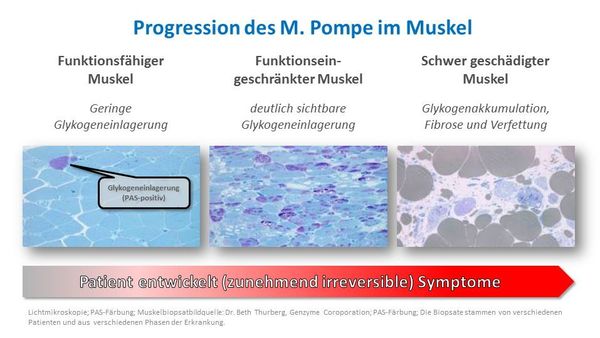 Abbildung der Progression des Morbus Pompe im Muskel
